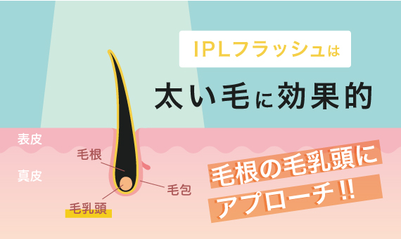 IPL脱毛とは？